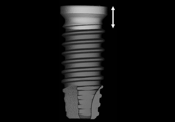Scaling of titanium implants entrains inflammation-induced osteolysis