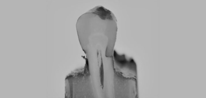 THE EFFECT OF GINGIVAL WALL LOCATION ON THE MARGINAL SEAL OF CLASS II RESTORATIONS PREPARED WITH A FLOWABLE BULK-FILL RESIN-BASED COMPOSITE